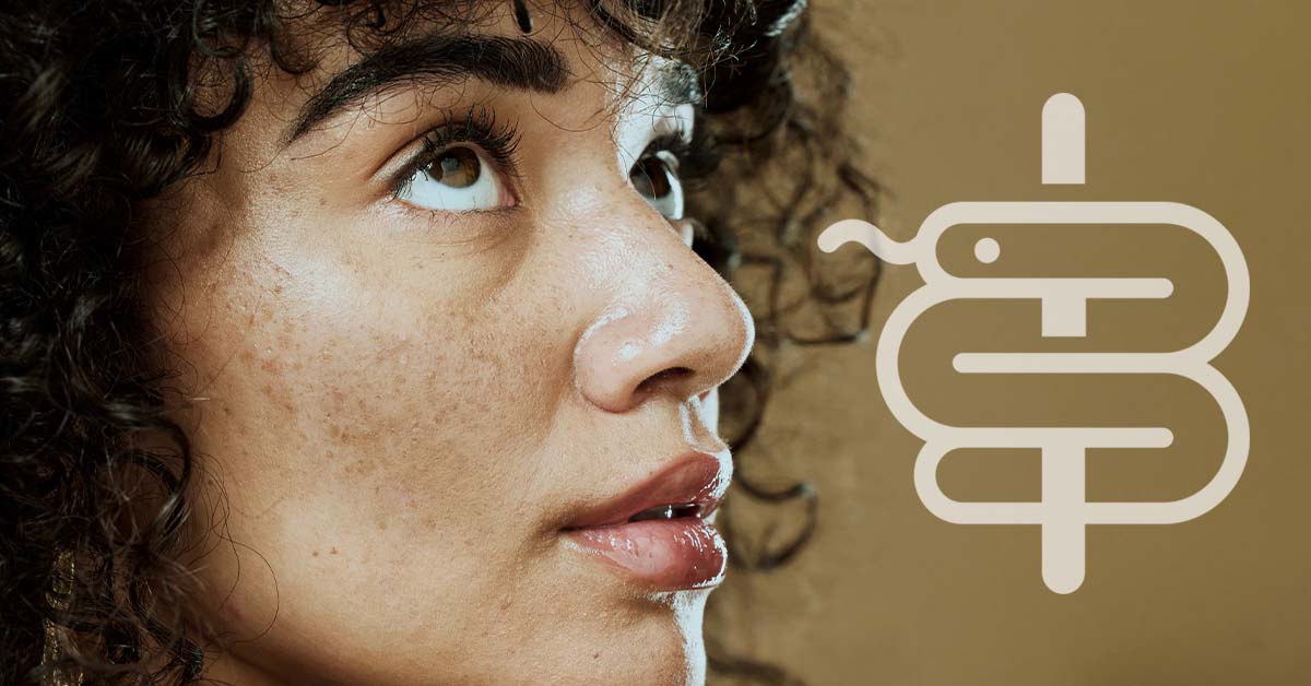 Melasma y manchas oscuras: causas y tratamientos
