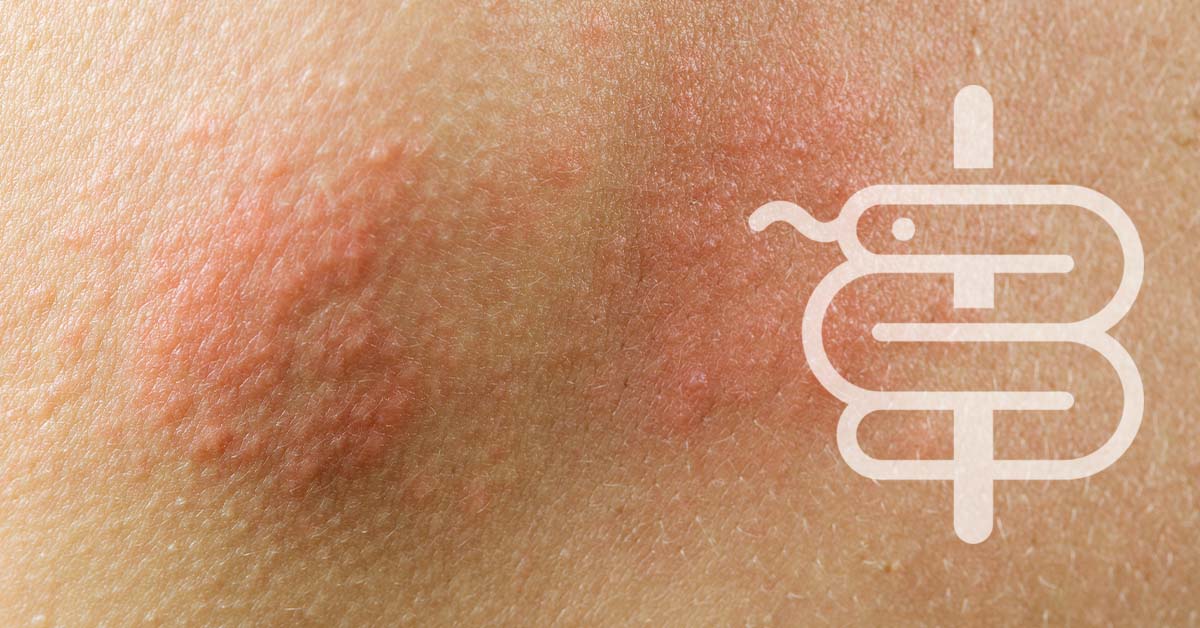 Eccema: qué es y cómo tratarlo correctamente