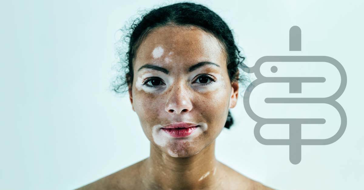 Vitiligo: opciones de tratamiento y cuidados diarios