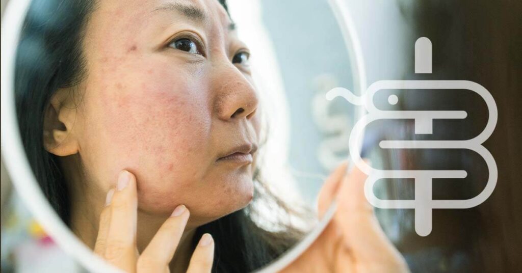 rosacea, causas, tipos y tratamiento