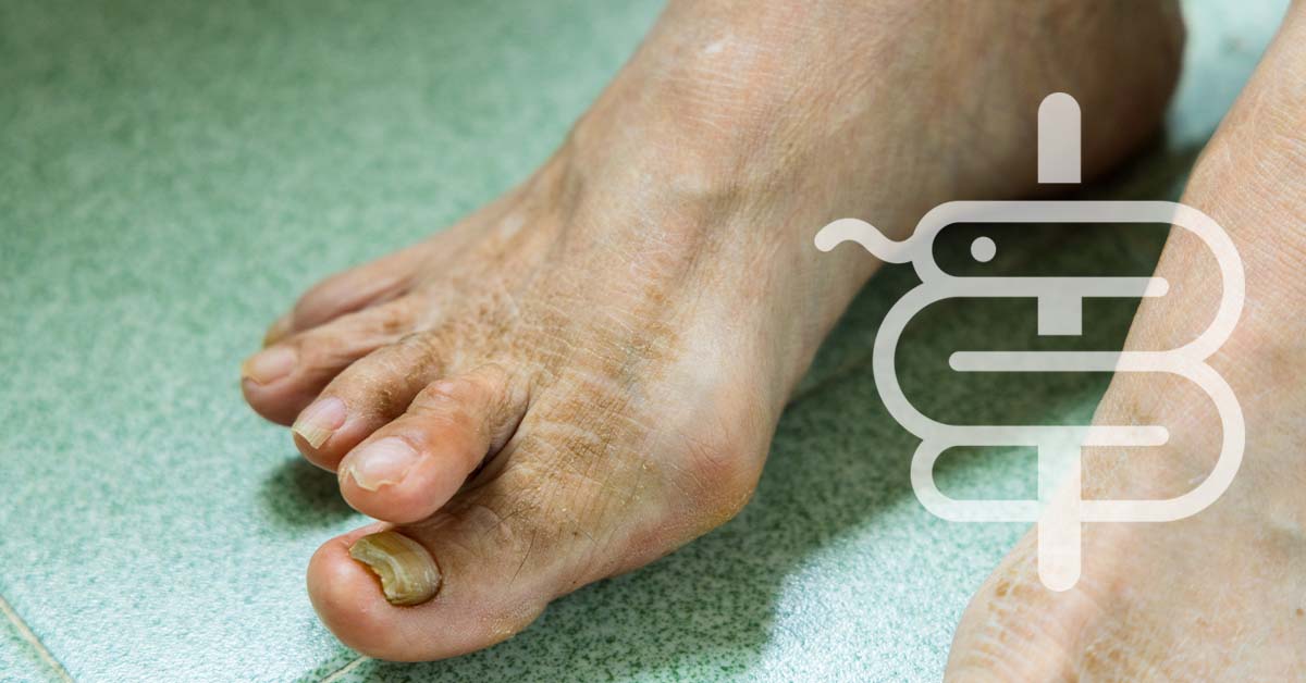 Hongos en las uñas: guía completa 2026 y tratamiento eficaz online