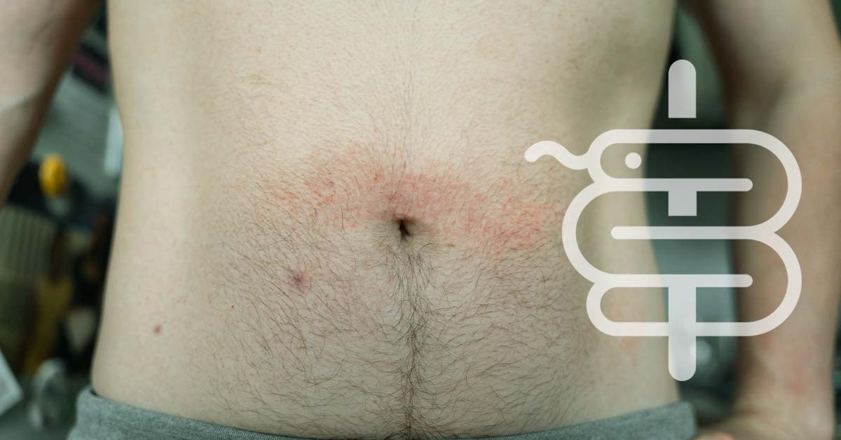 Tiña corporal: cómo identificar y tratar esta infección