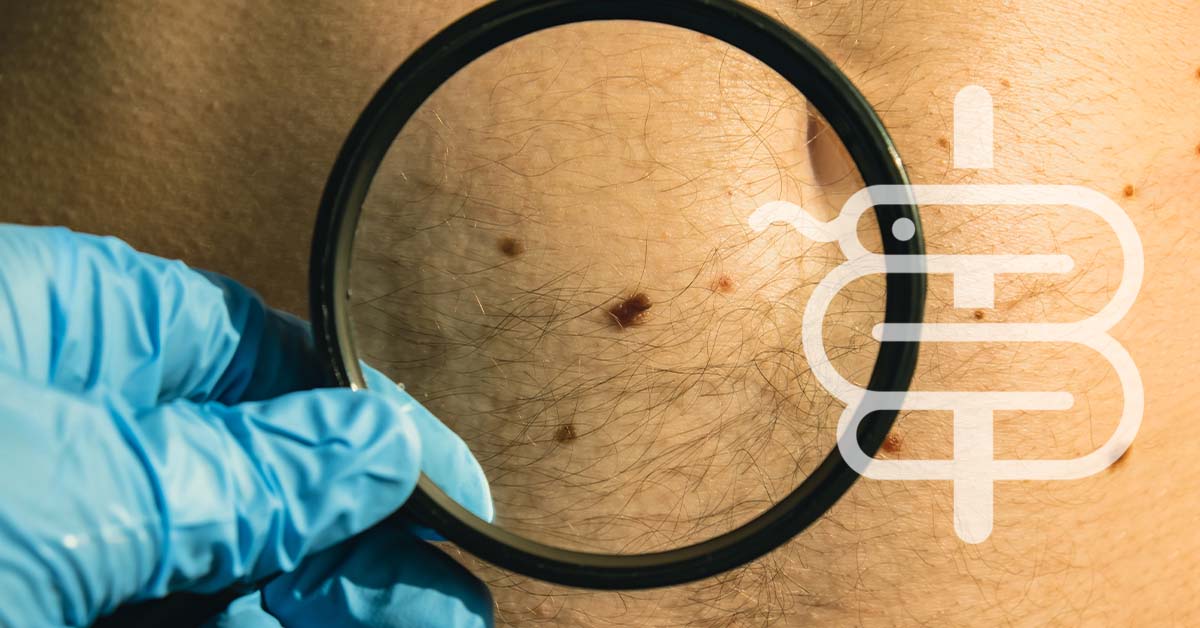 Lunares: cuándo preocuparse y consultar a un dermatólogo