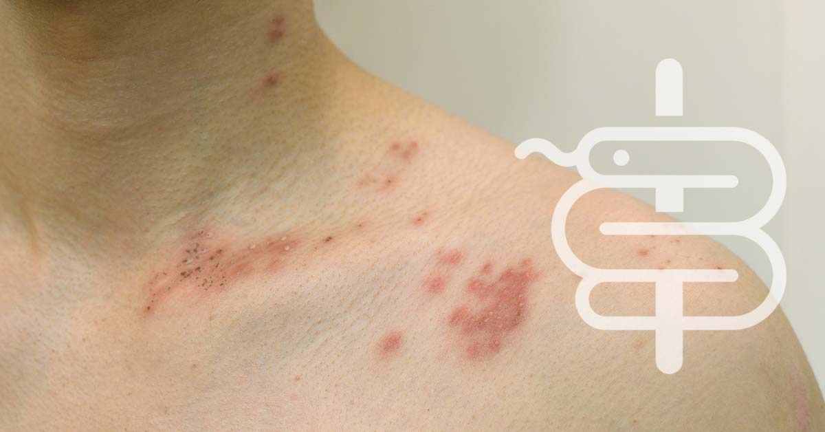 Herpes zóster: síntomas, tratamiento y prevención