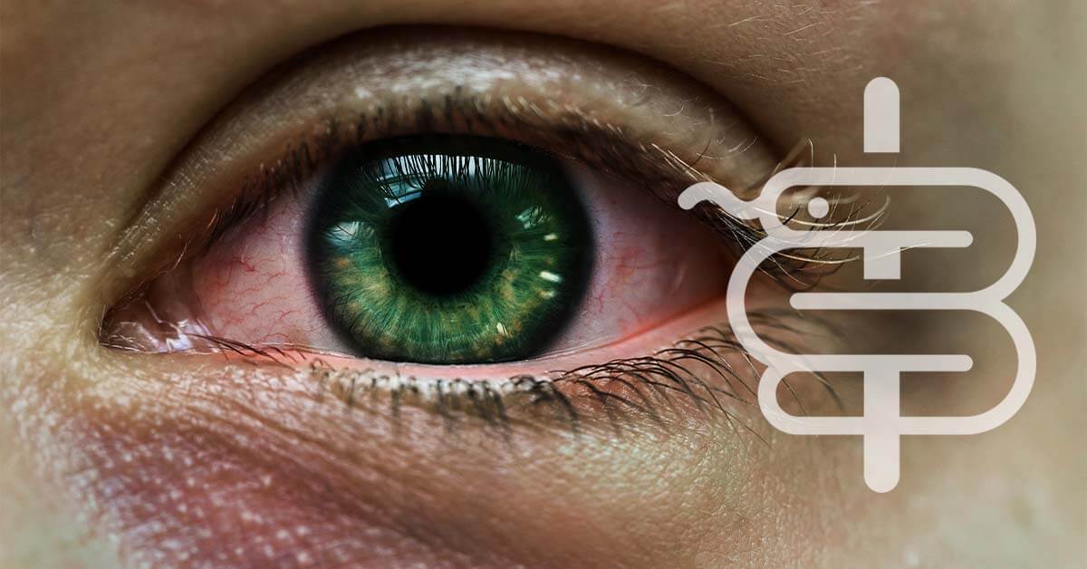 Rosácea ocular: señales de alerta y tratamiento