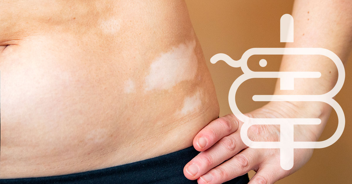 Manchas blancas en la piel: vitiligo, hongos u otra causa?