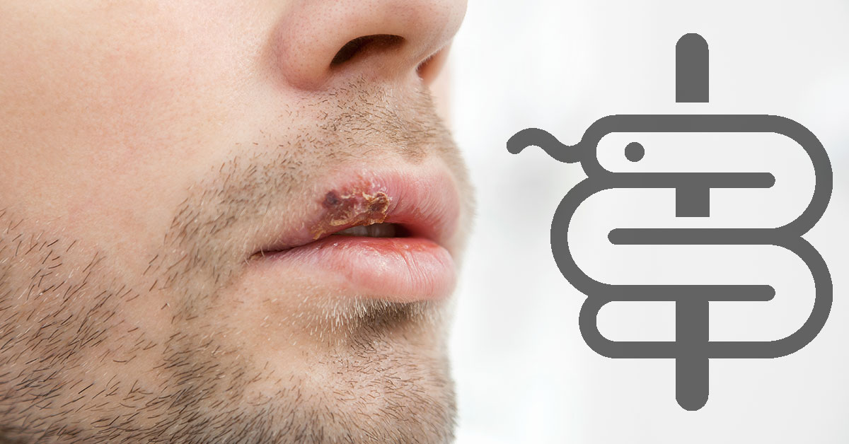 Diferencias entre herpes zóster y herpes simple: cómo saber cuál tenés