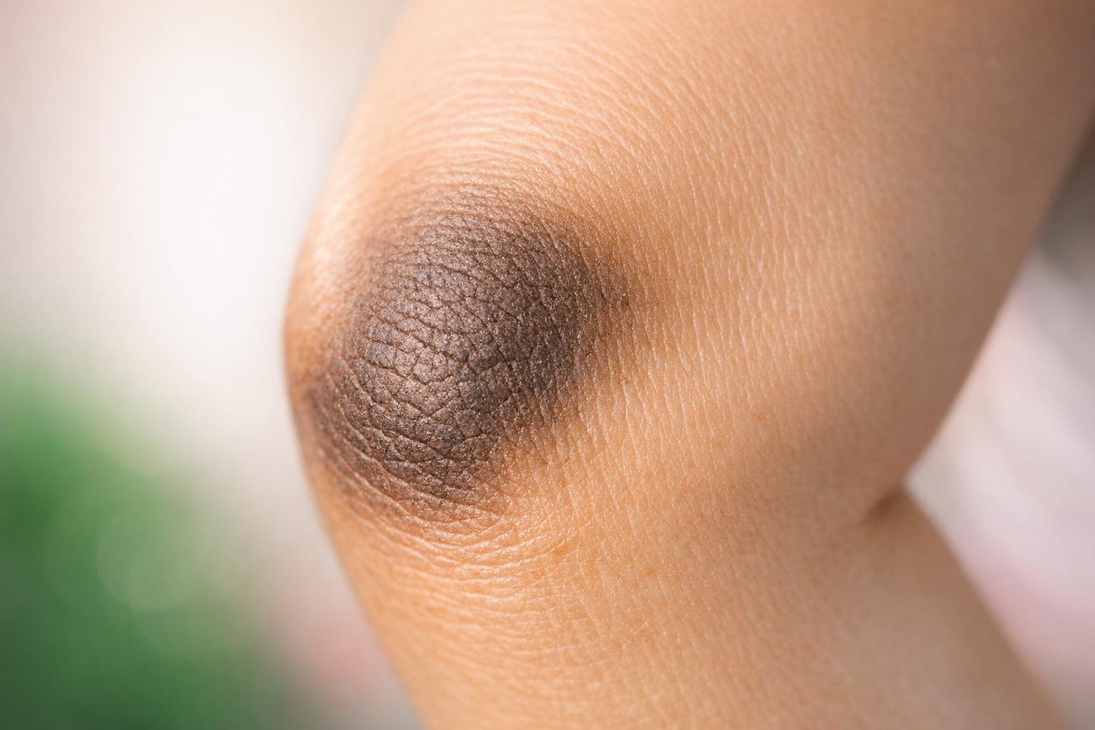 Zonas resecas y oscuras: relación entre fricción, hidratación y queratosis