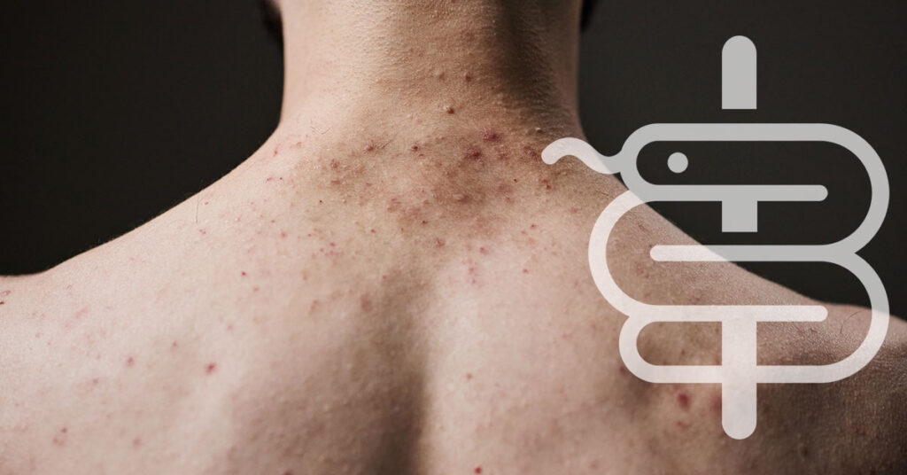 manchas en hombro y espalda de acne a hiperpigmentacion