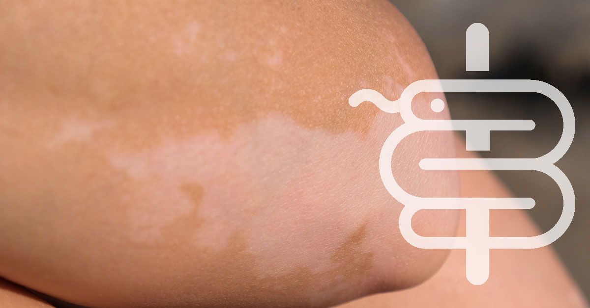Despigmentación irregular: cuándo se debe a infección, resequedad o vitiligo