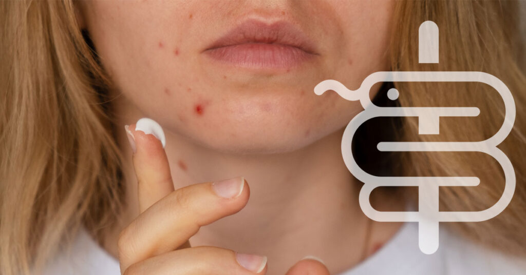 acne y protector solar