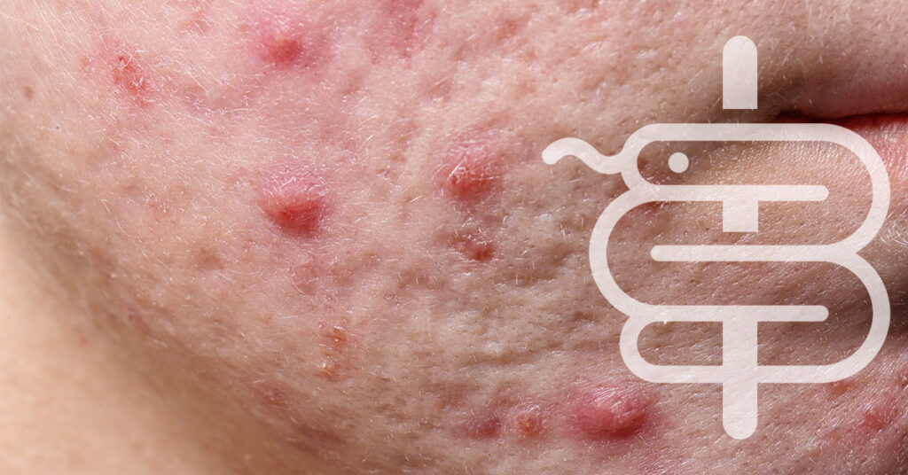 isotretinoina-roacutan